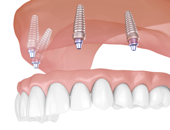  Prothèse dentaire sur implants