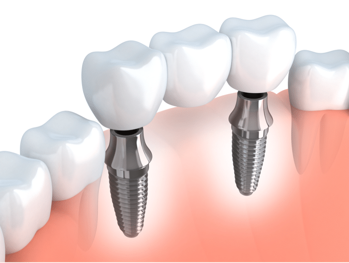 Implants de plusieurs dents