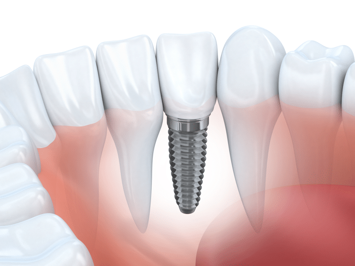 Implant d'une dent