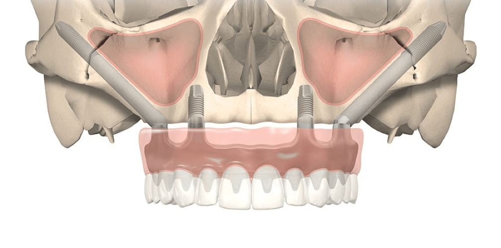 Implants Zigomatique