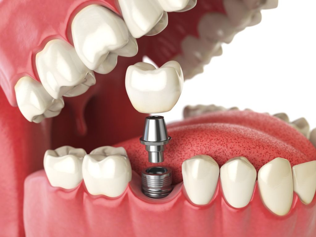 installation implant dentaire
