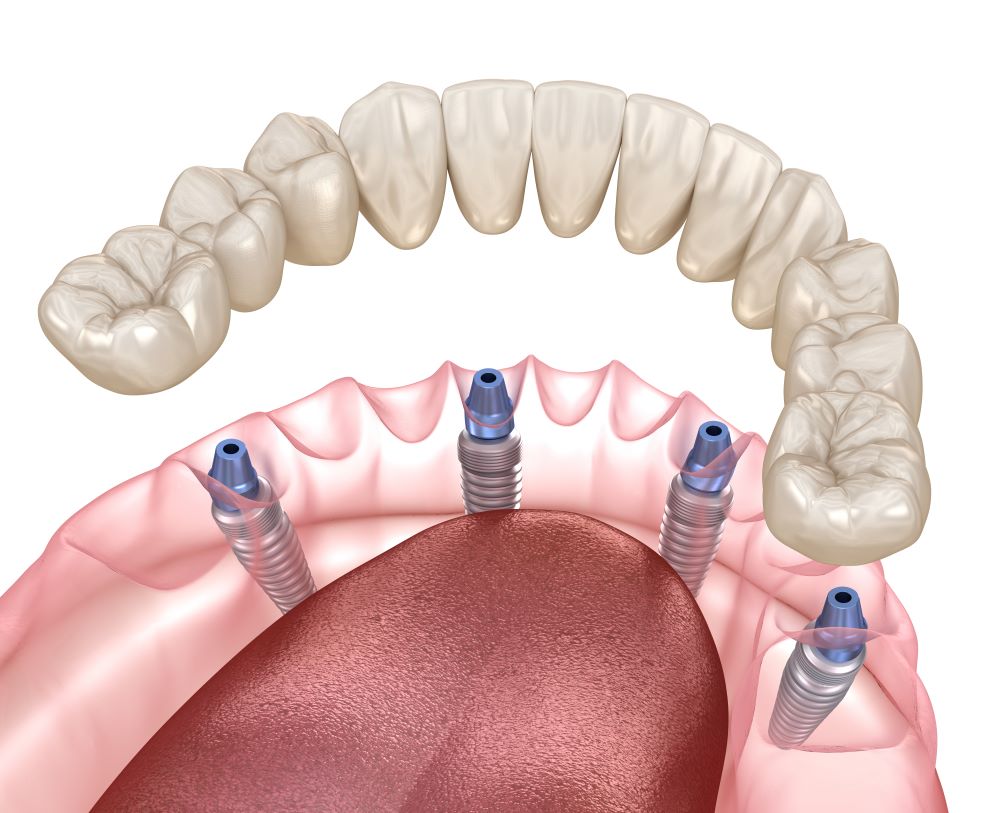 Implants-dentaires-all-on-four-quoi-savoir