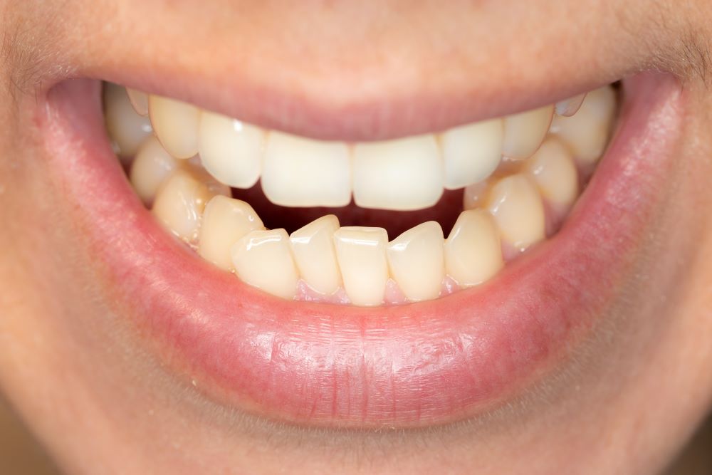 conséquences malocclusion dentaire