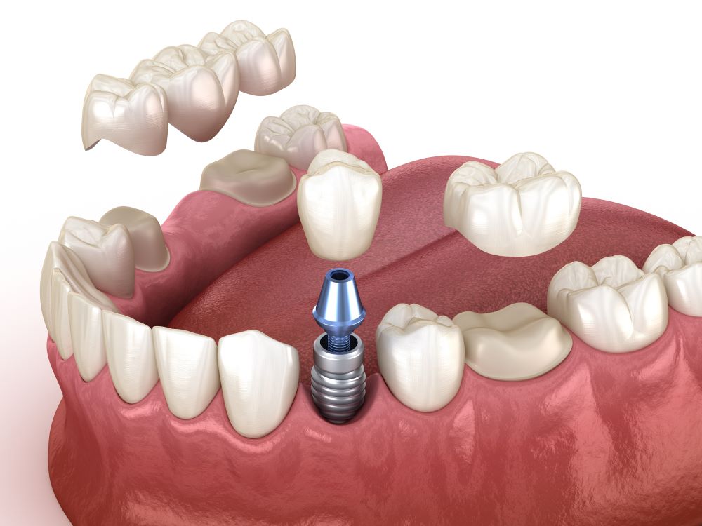 différence implant couronne dentaire