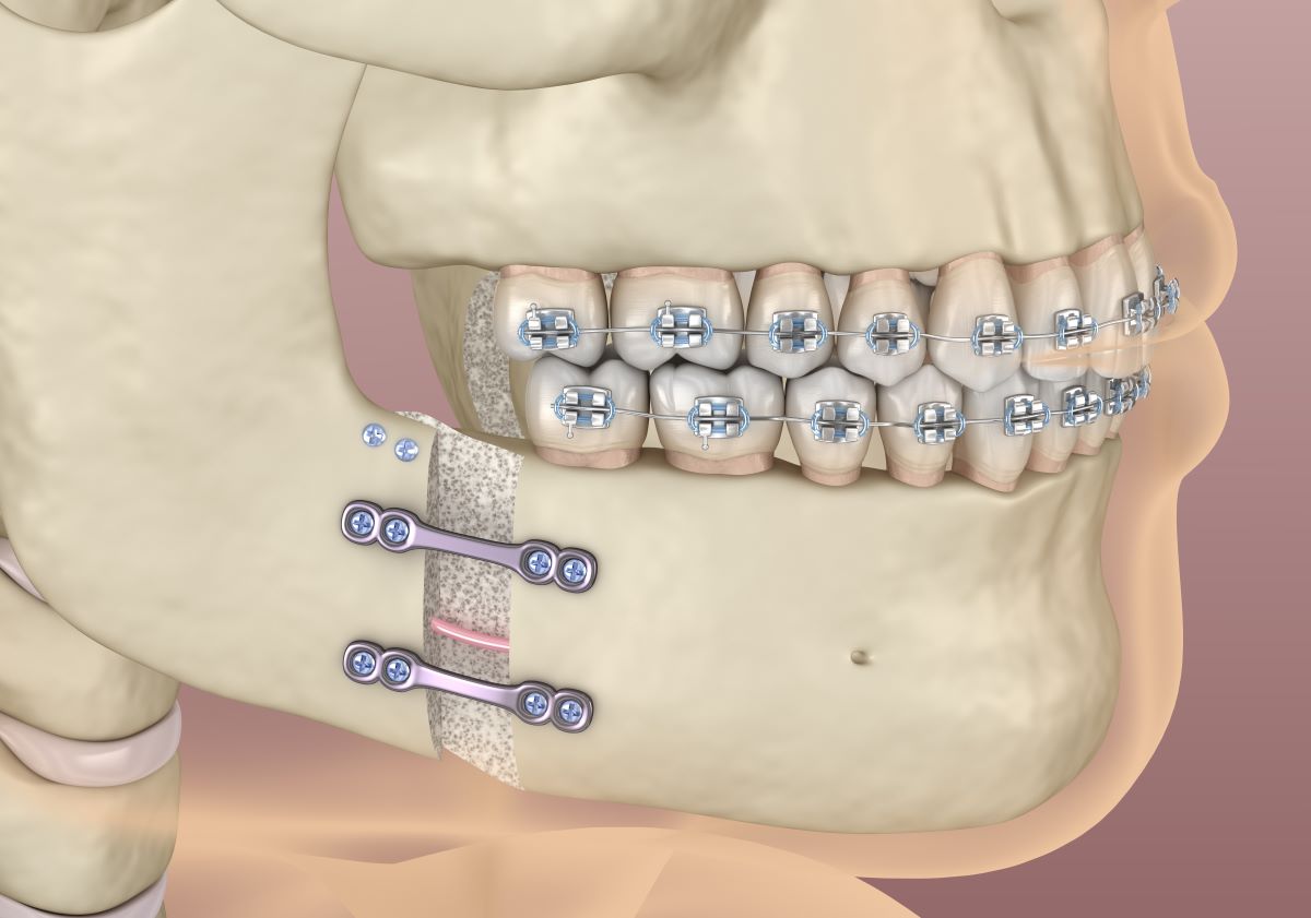 An Overview of Mandibular Osteotomy | Jaw Surgery