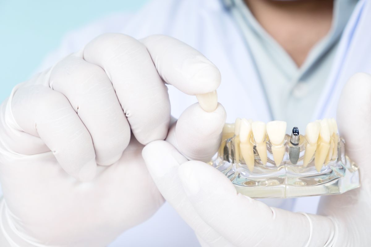 tout savoir sur les implants dentaires